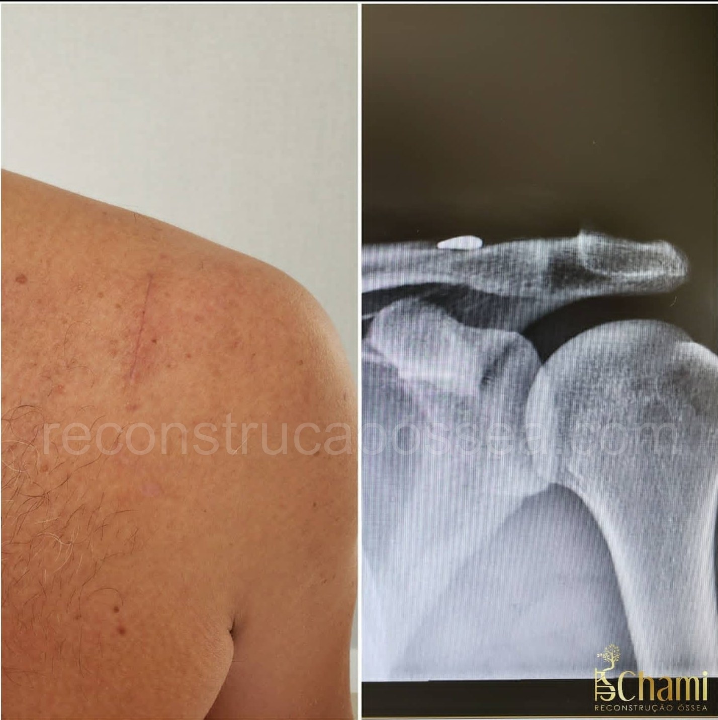 cirurgia-ortopedica-minimamente-invasiva-10