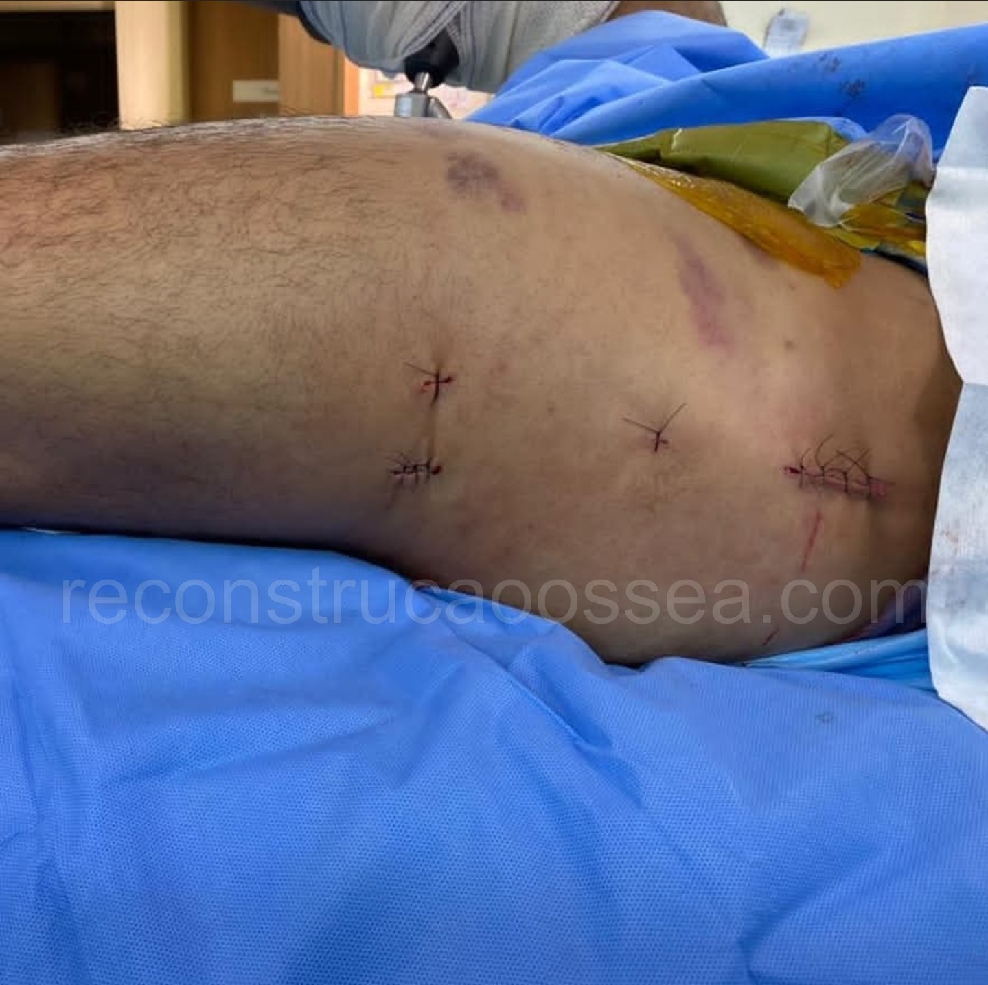 cirurgia-ortopedica-minimamente-invasiva-13