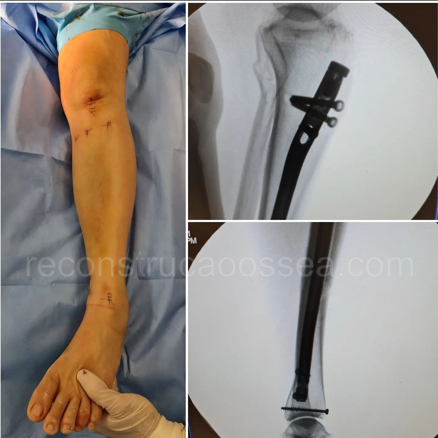 cirurgia-ortopedica-minimamente-invasiva-20