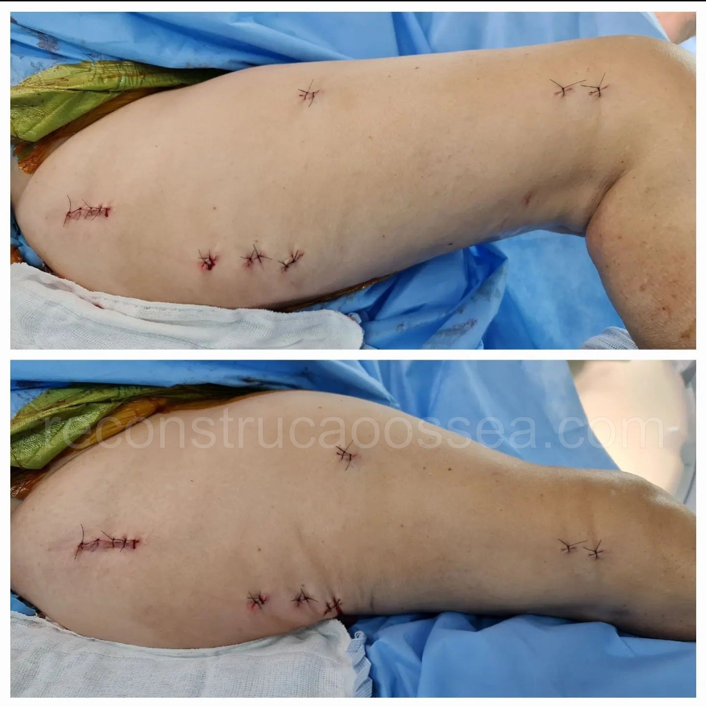 cirurgia-ortopedica-minimamente-invasiva-27