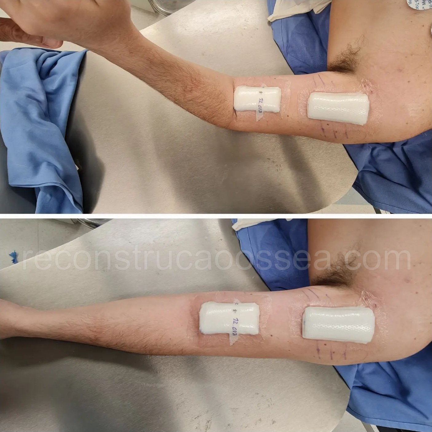 cirurgia-ortopedica-minimamente-invasiva-30