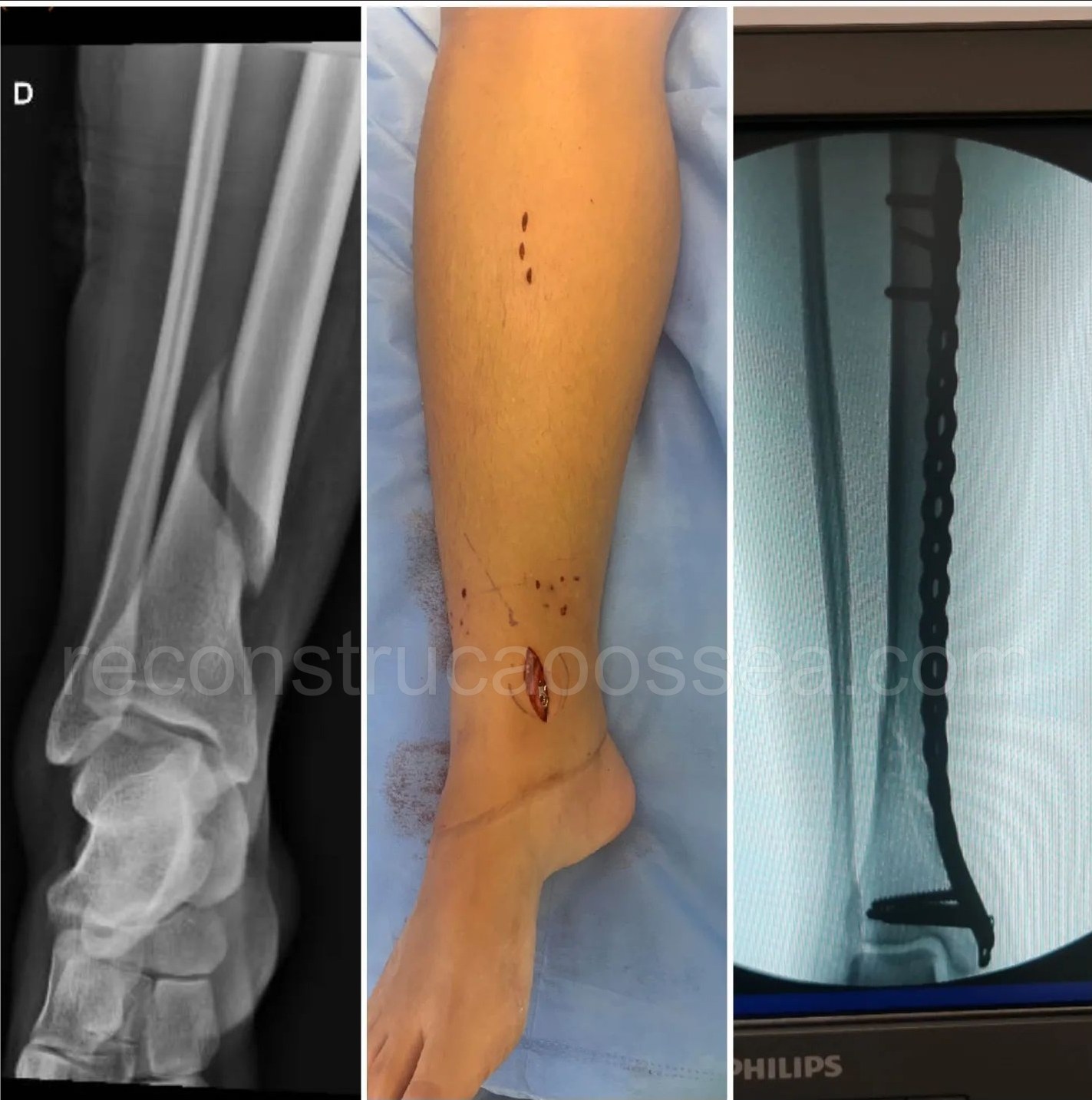 cirurgia-ortopedica-minimamente-invasiva-31