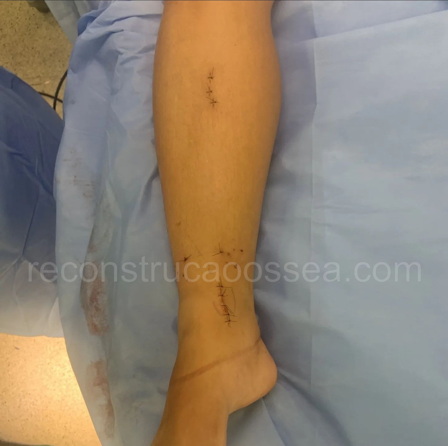 cirurgia-ortopedica-minimamente-invasiva-32