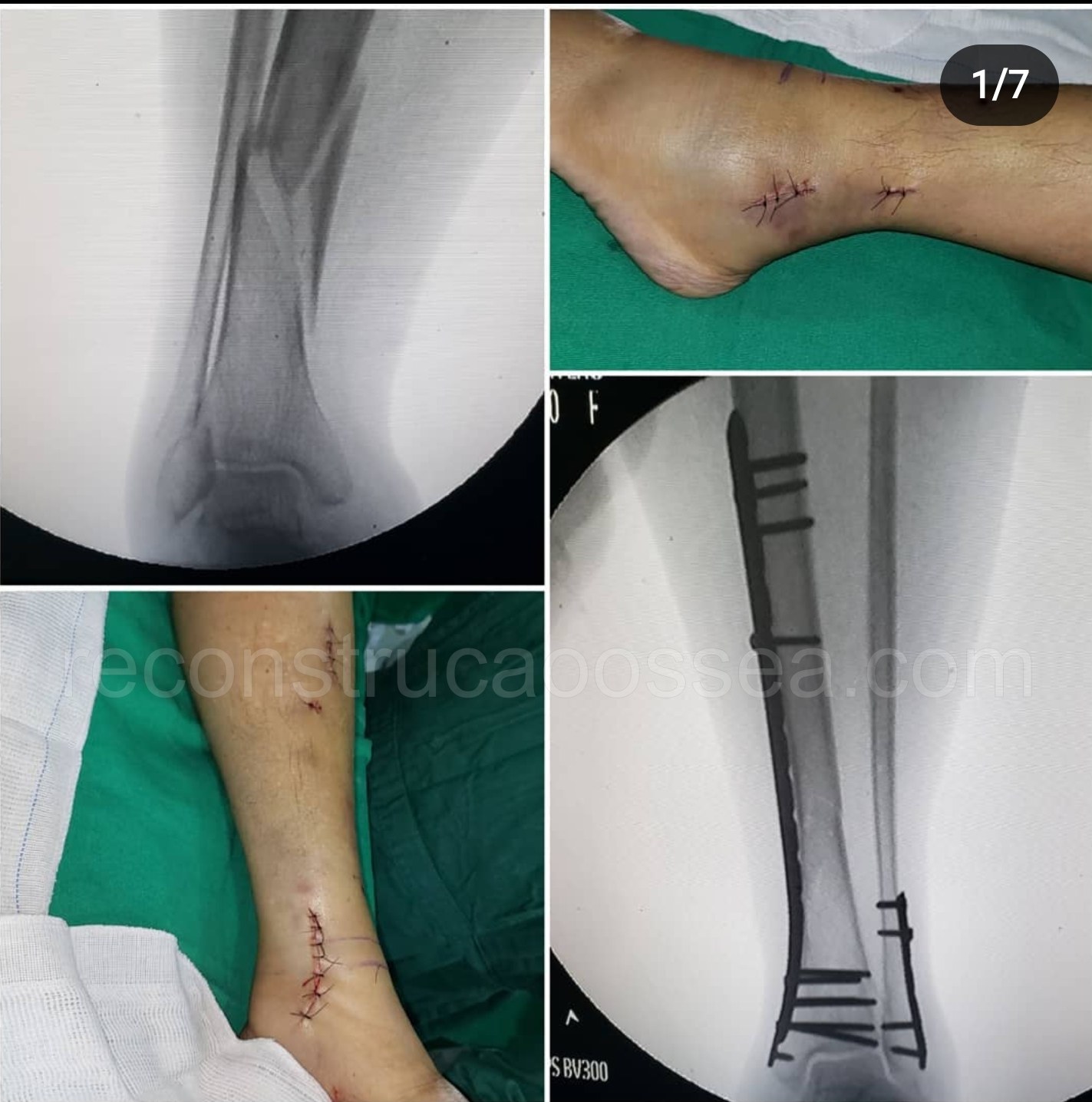 cirurgia-ortopedica-minimamente-invasiva-4