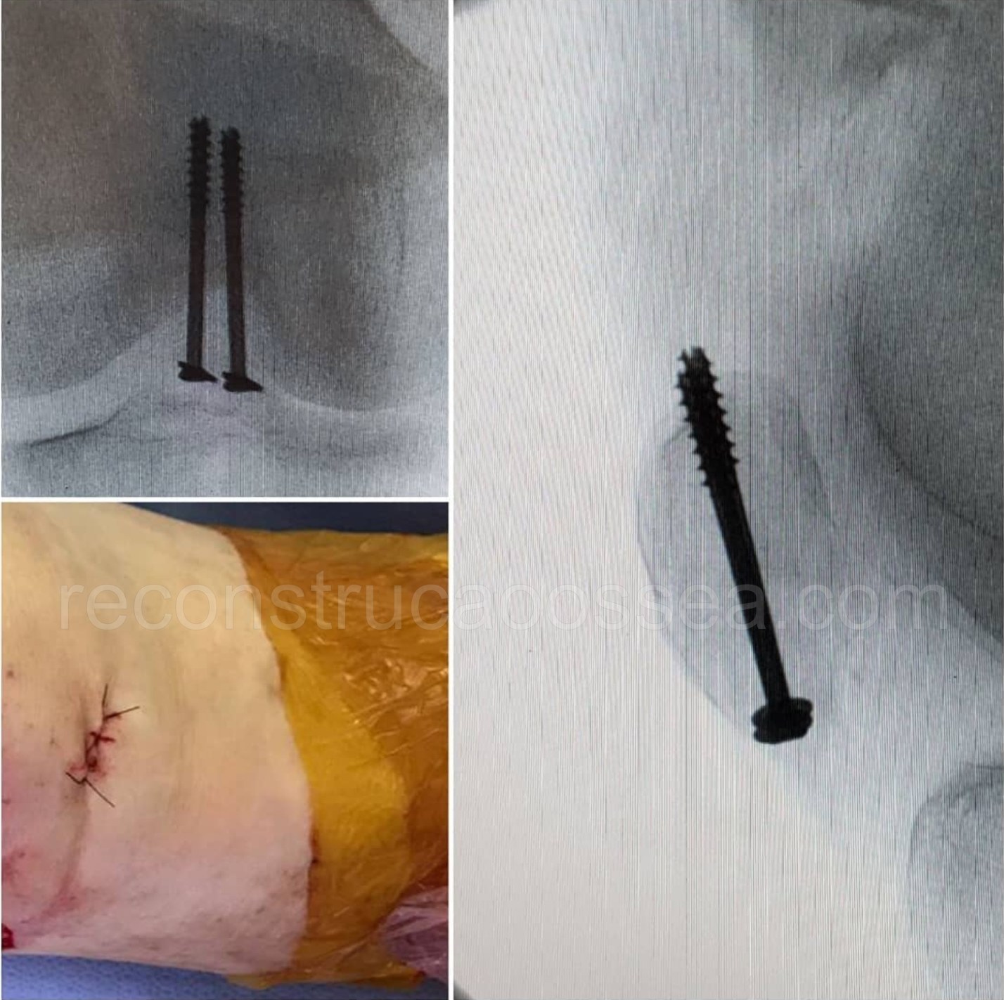 cirurgia-ortopedica-minimamente-invasiva-9