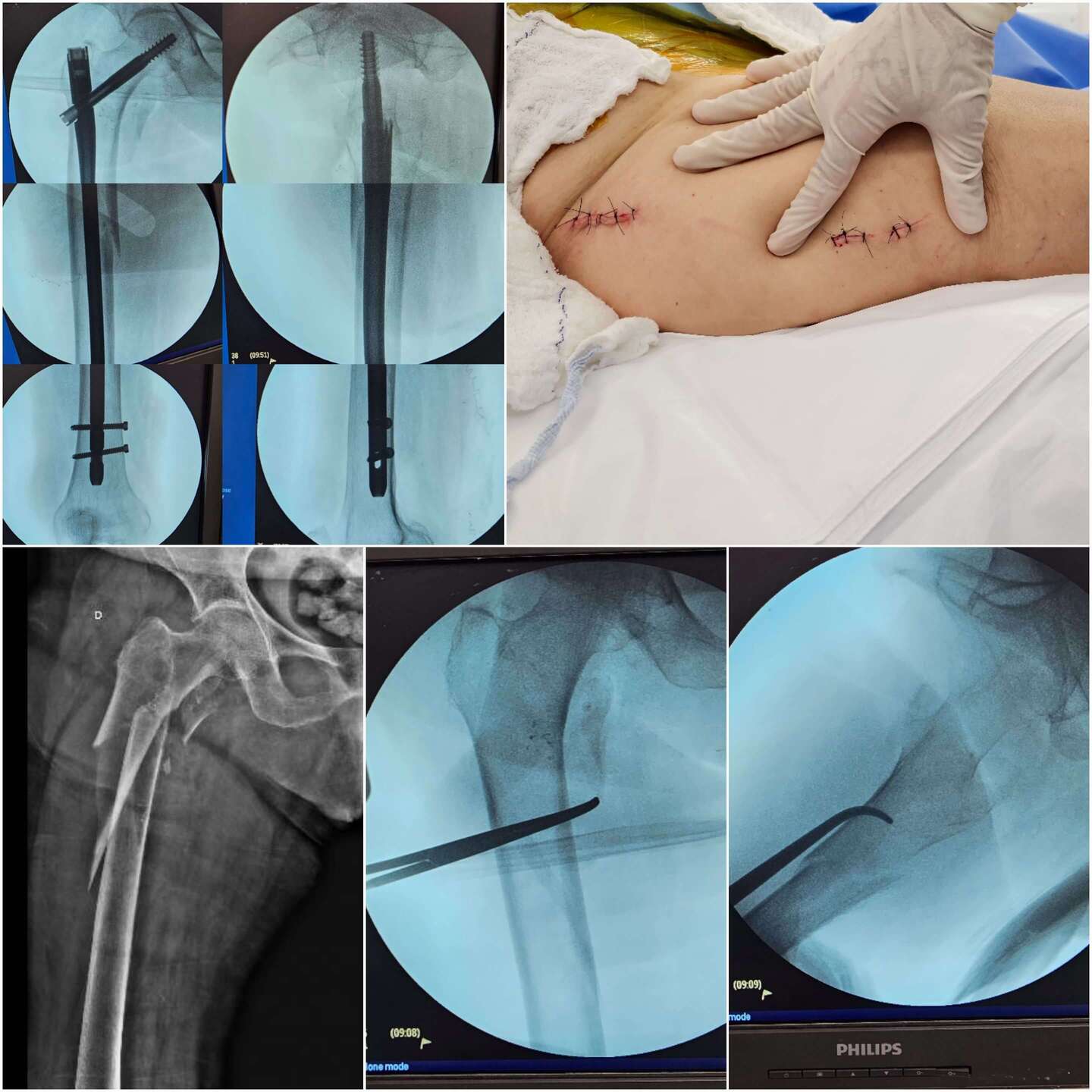 cirurgia-minimamente-invasiva-2