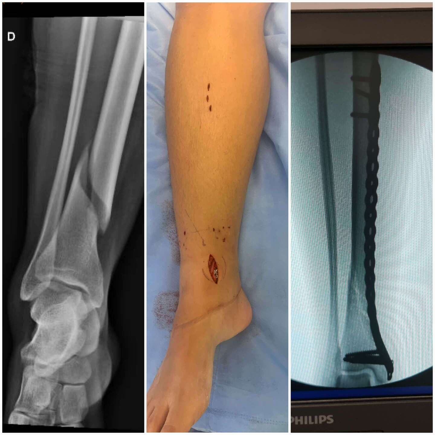 cirurgia-minimamente-invasiva-8