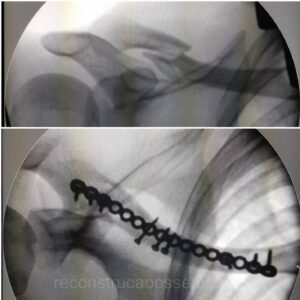 fratura-da-clavicula-3