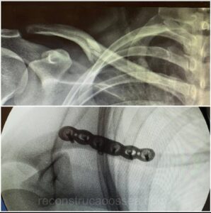 fratura-da-clavicula-5