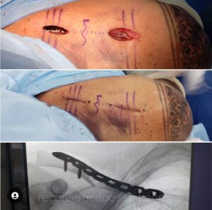 fratura-da-clavicula-6