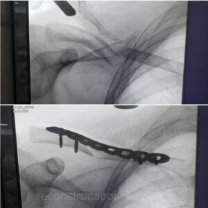 fratura-da-clavicula-7