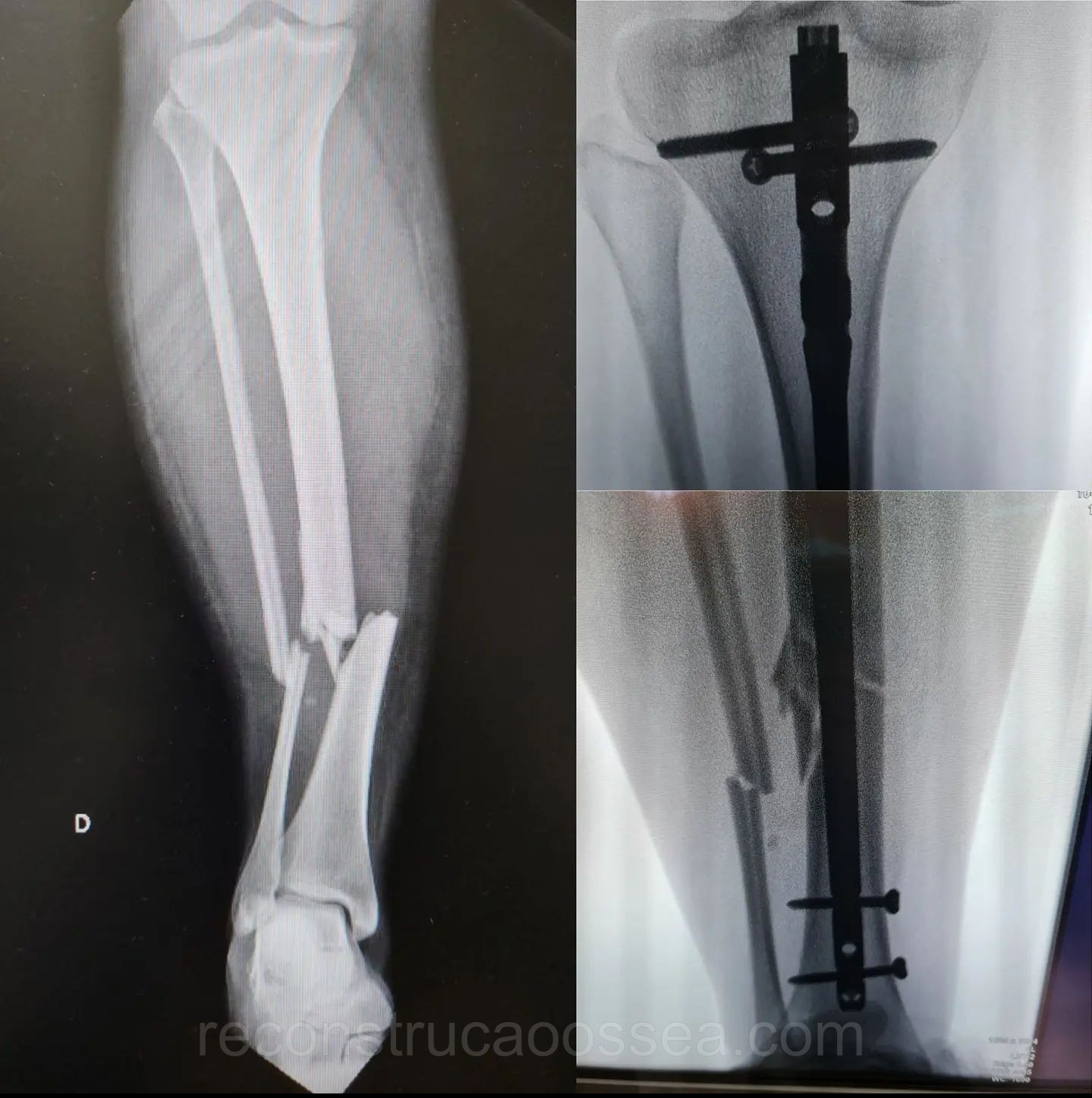 fratura-da-tibia-10