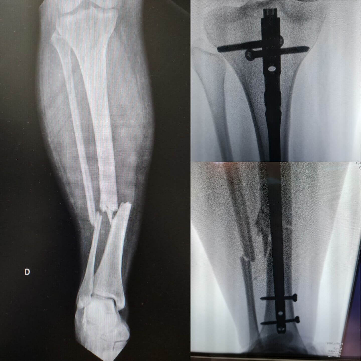 fratura-da-tibia-10