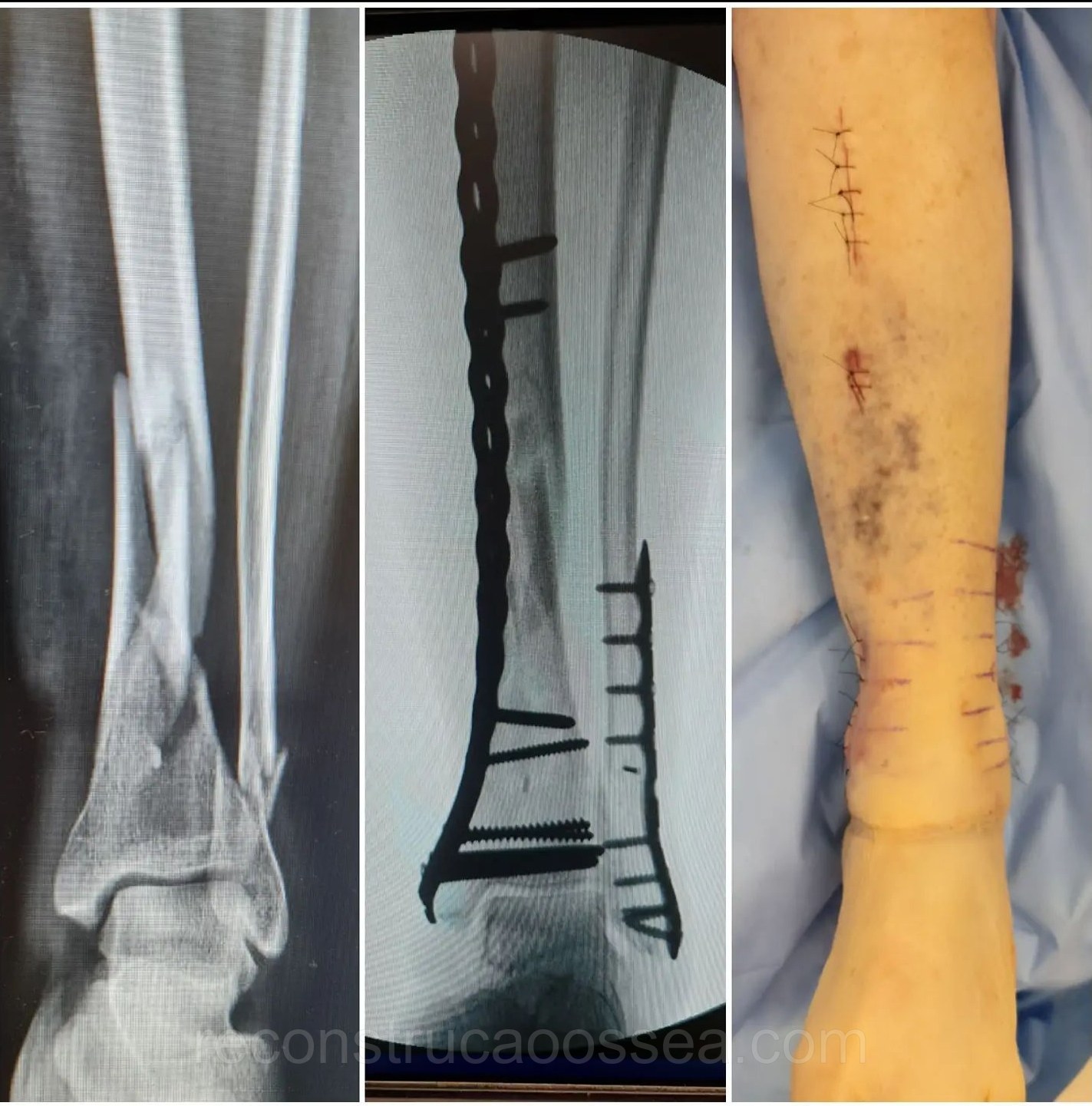 fratura-da-tibia-11