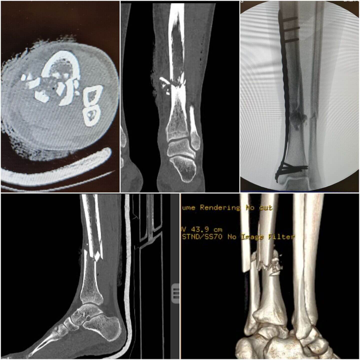 fratura-da-tibia