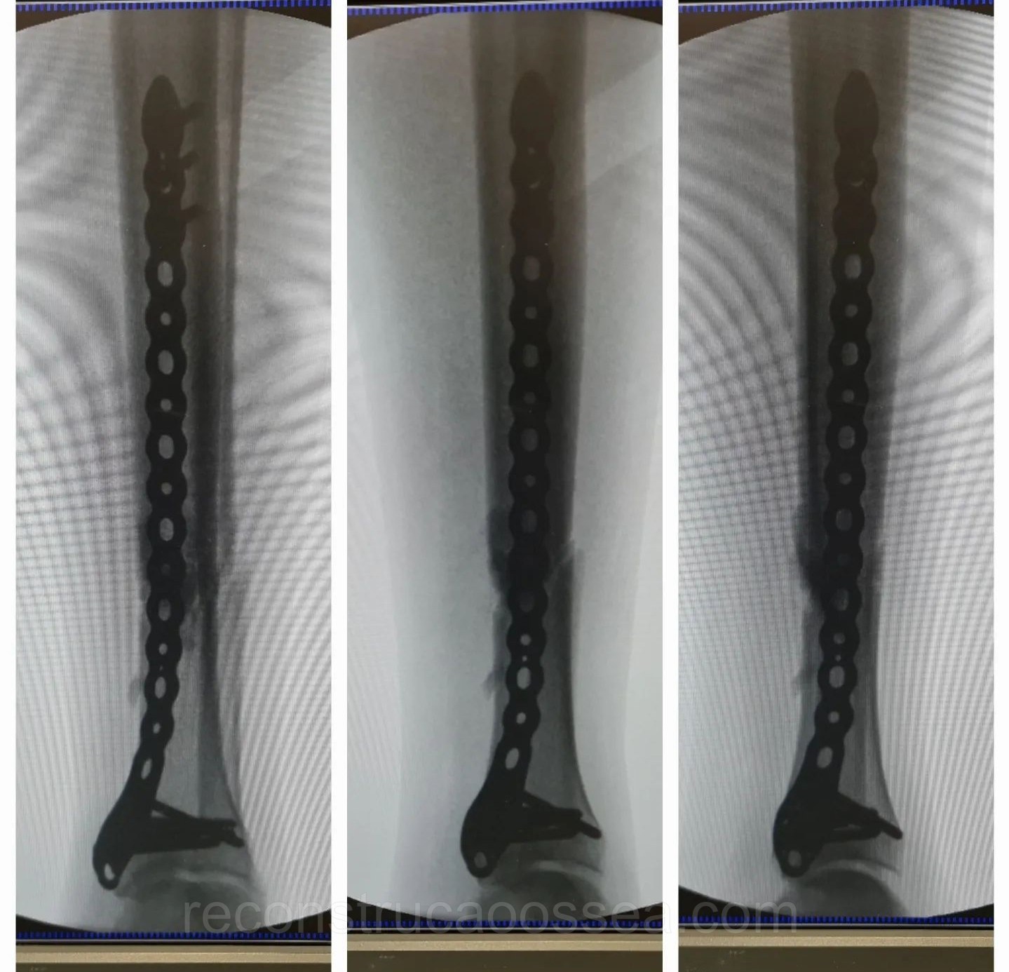fratura-da-tibia-20
