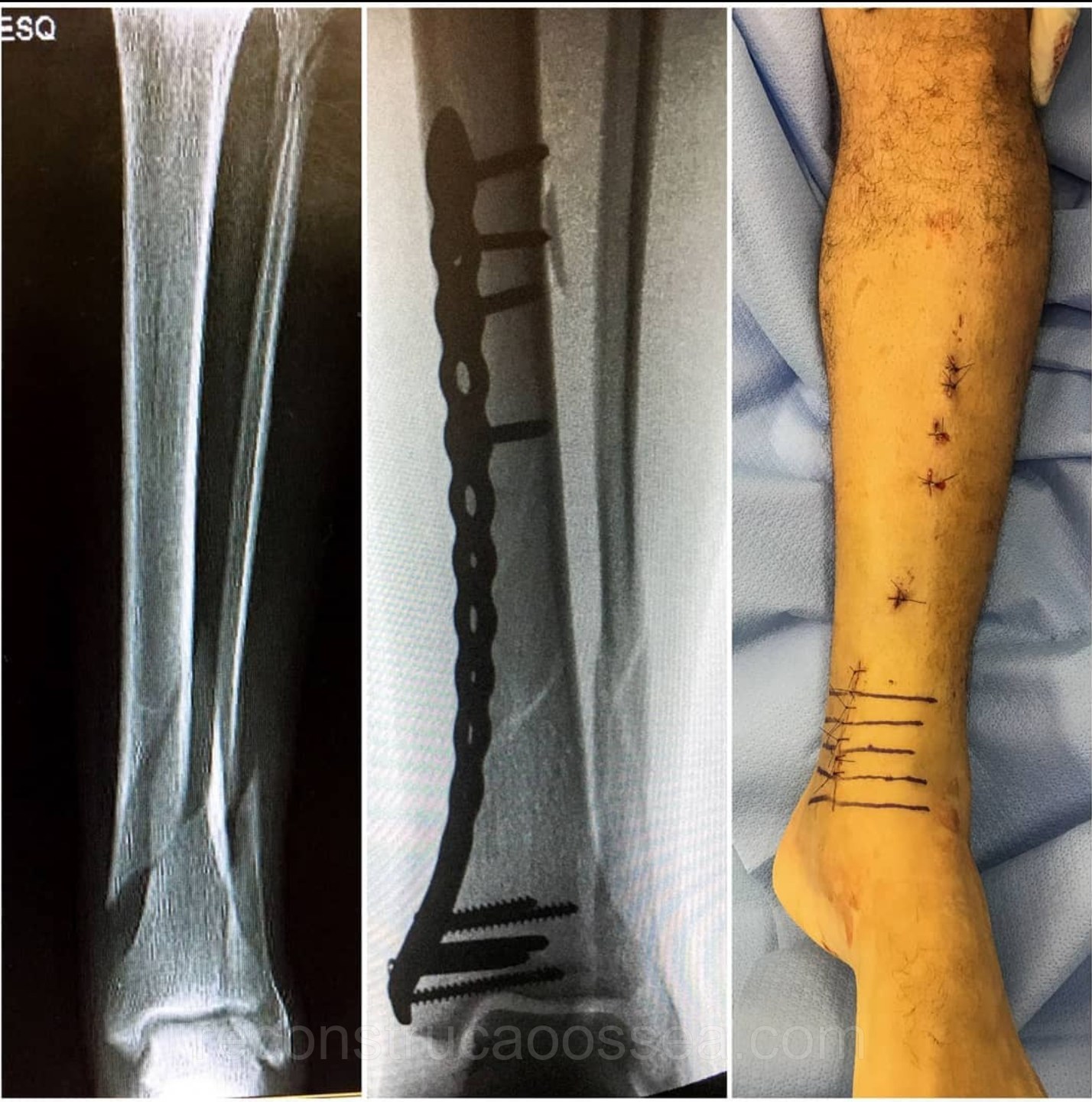 fratura-da-tibia-3