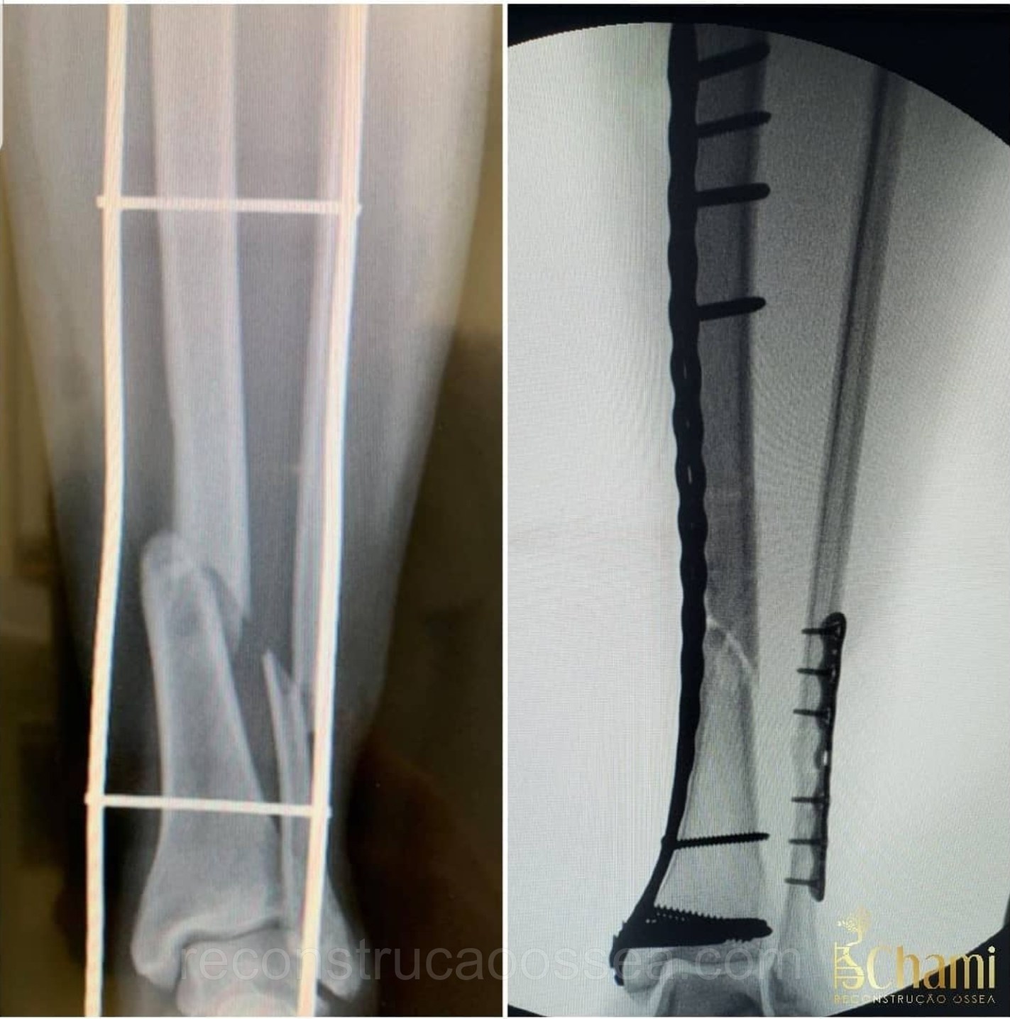 fratura-da-tibia-5