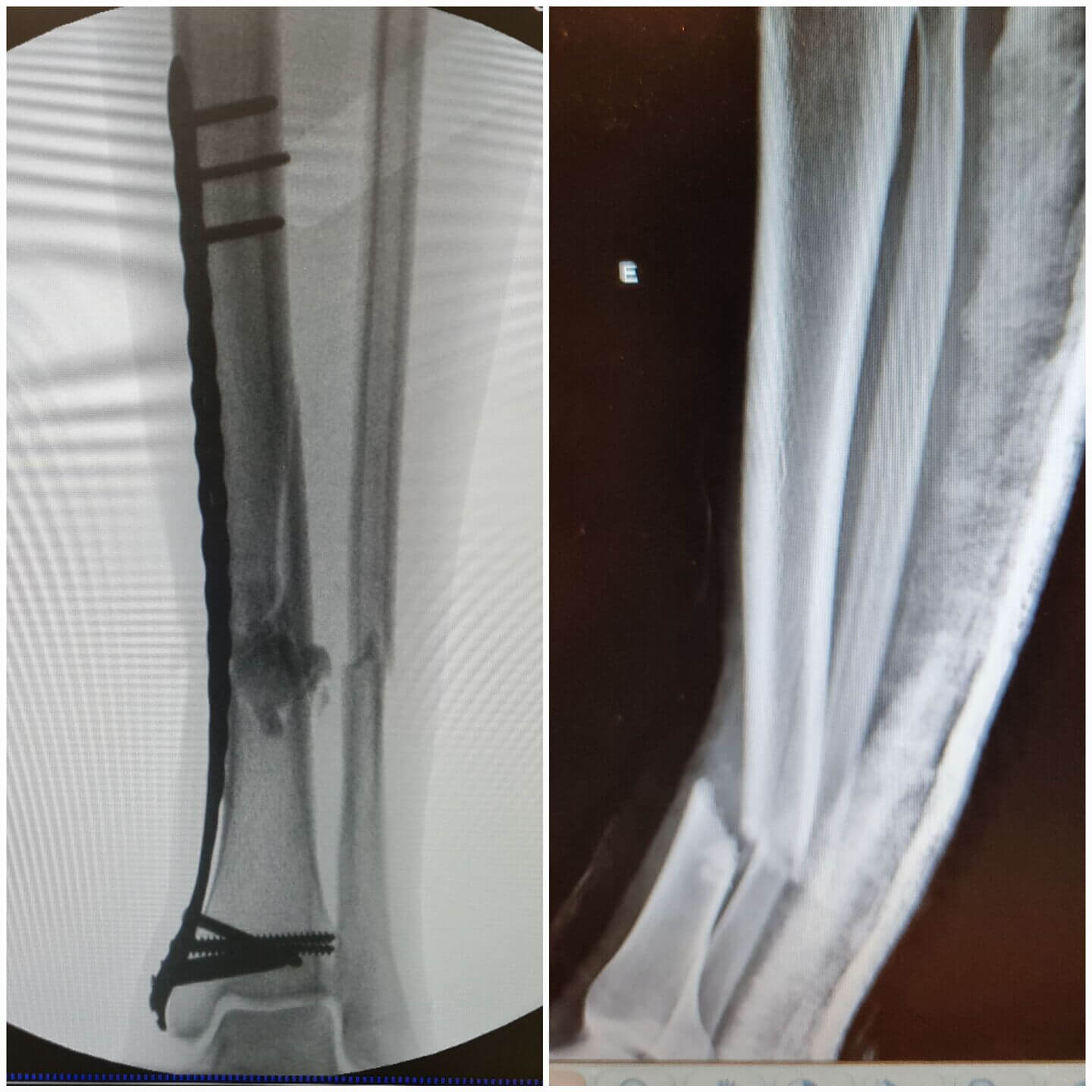 fratura-da-tibia-6