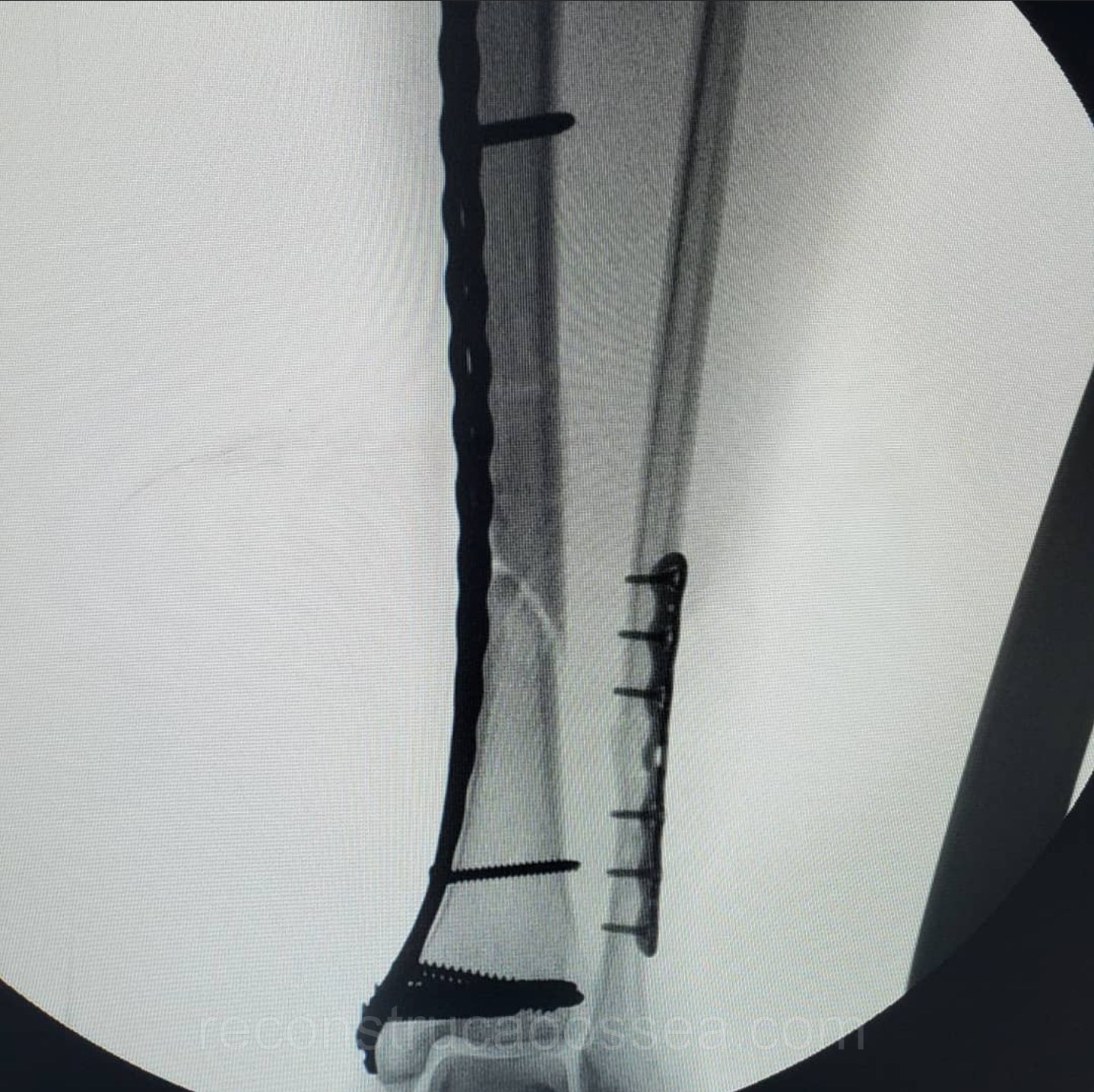 fratura-da-tibia-7