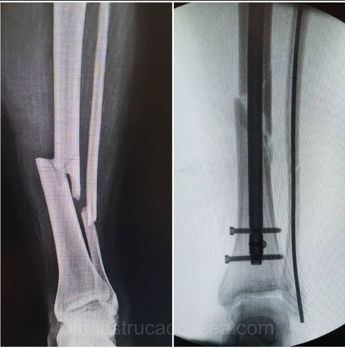 fratura-da-tibia-8