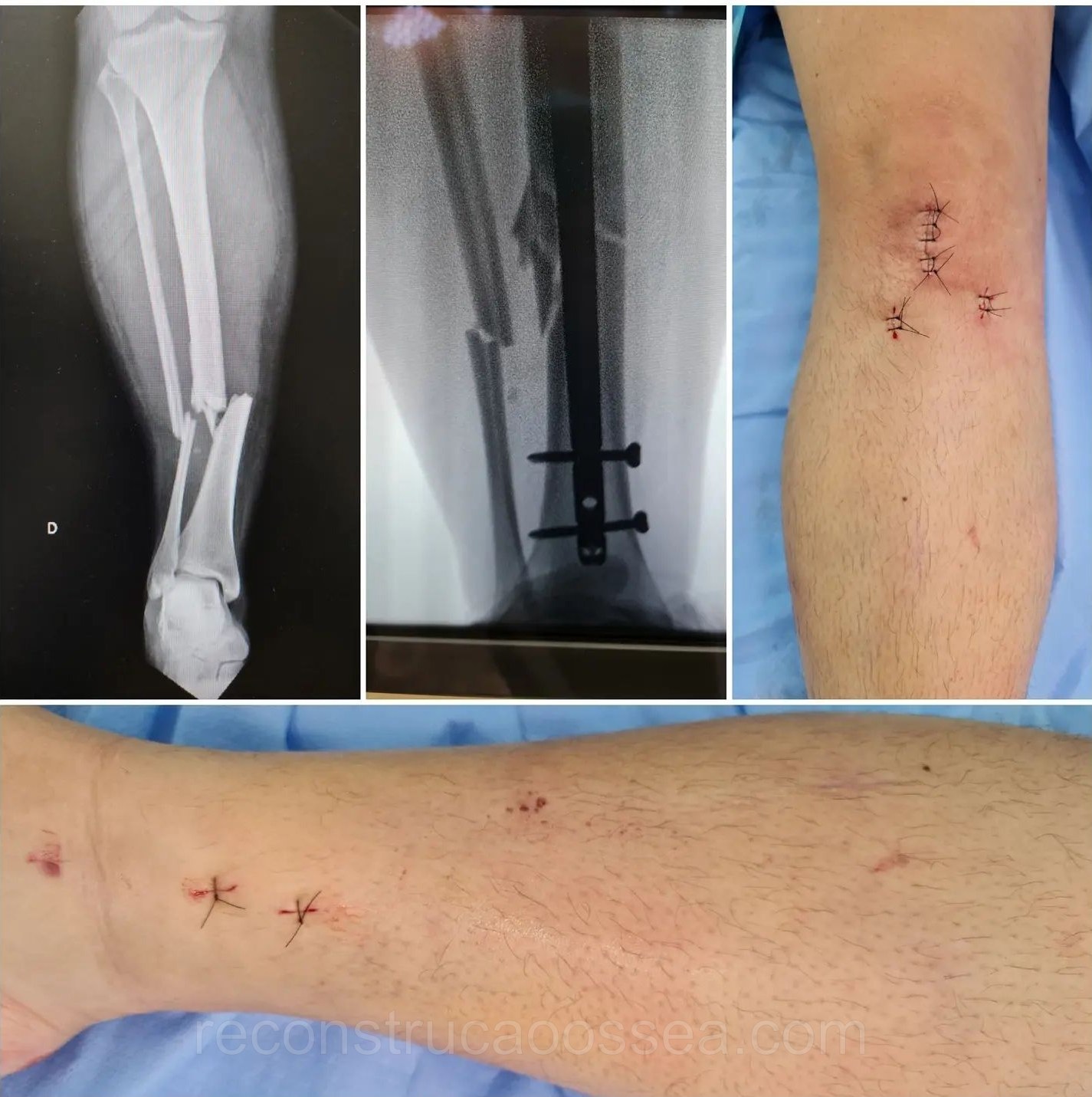 fratura-da-tibia-9