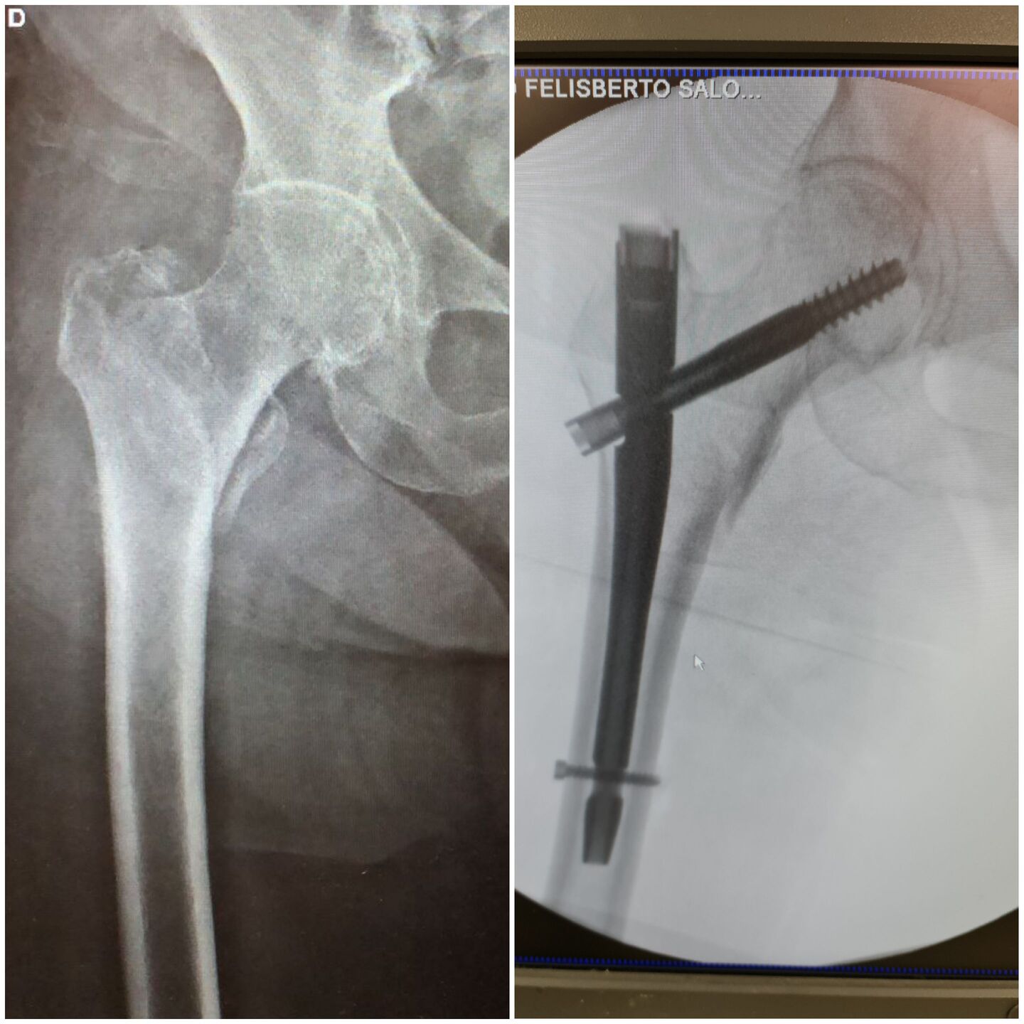 fratura-do-13-proximal-do-femur-10