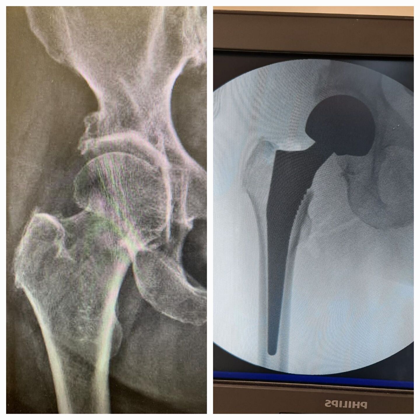 fratura-do-13-proximal-do-femur-11
