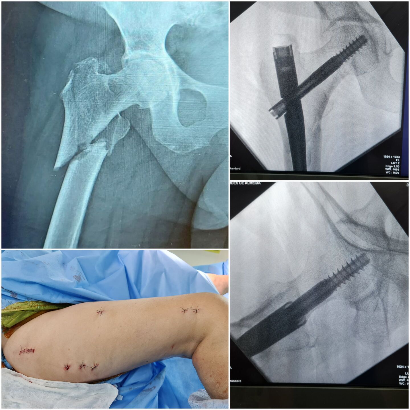 fratura-do-13-proximal-do-femur-13