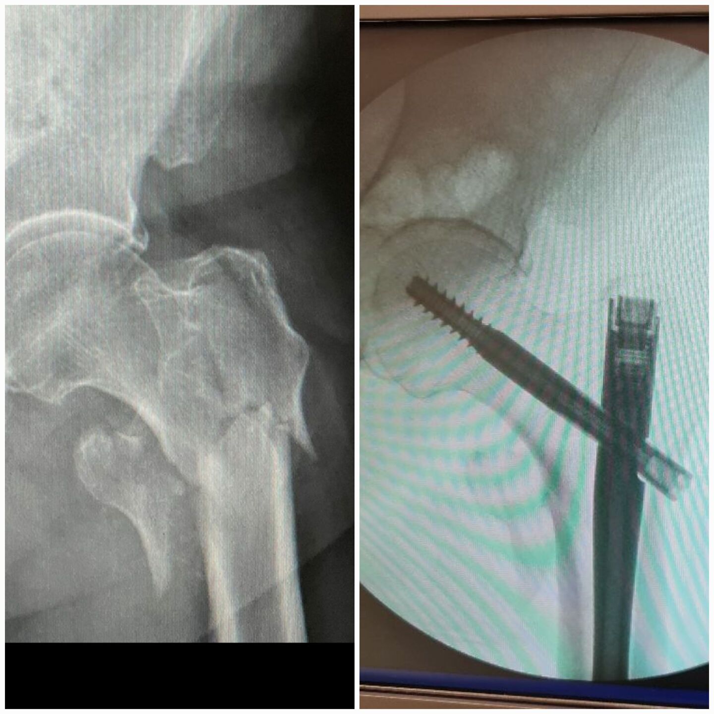 fratura-do-13-proximal-do-femur-15