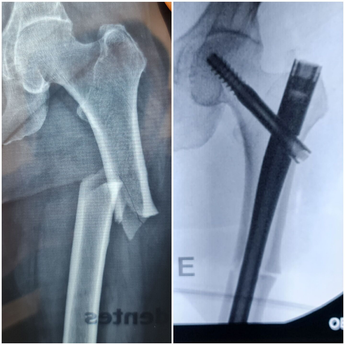 fratura-do-13-proximal-do-femur-2