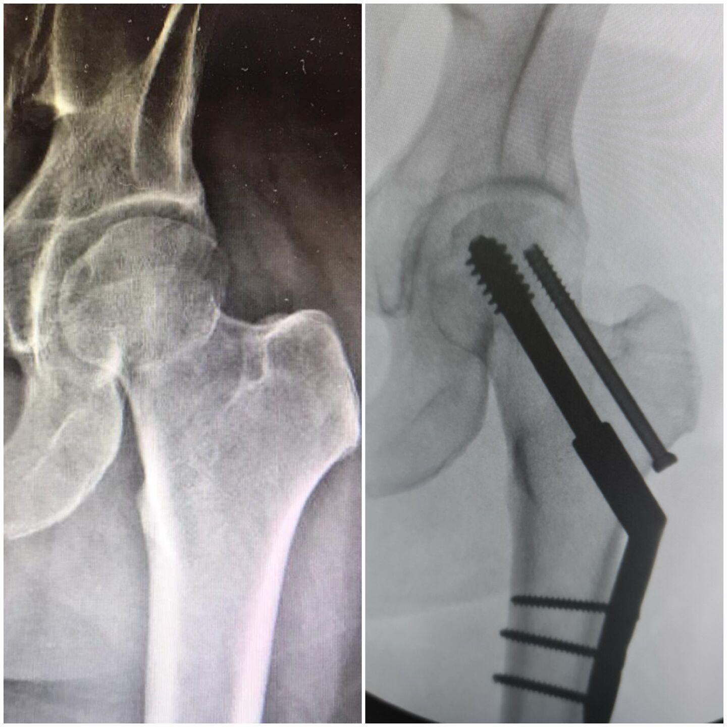 fratura-do-13-proximal-do-femur-6