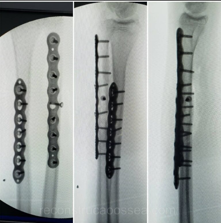 fratura-do-antebraco-6