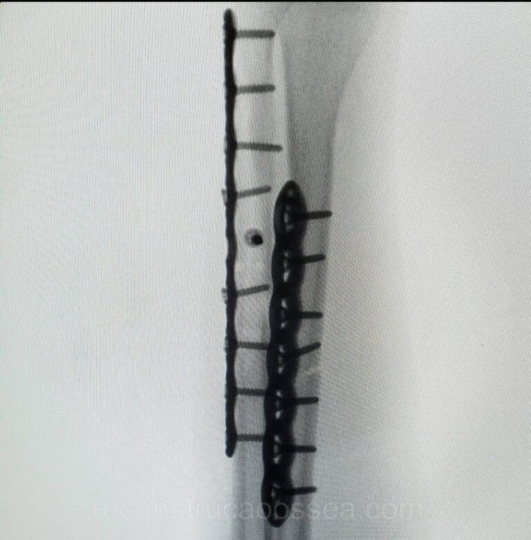 fratura-do-antebraco-7