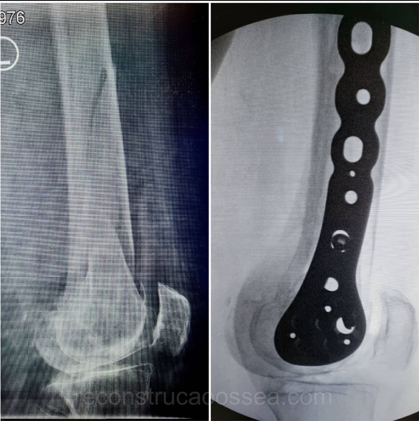 fratura-do-femur-distal-2