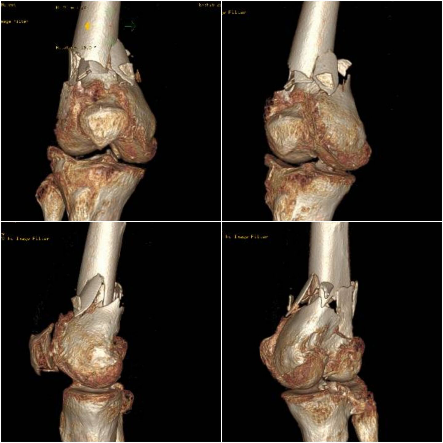 fratura-do-femur-distal-4