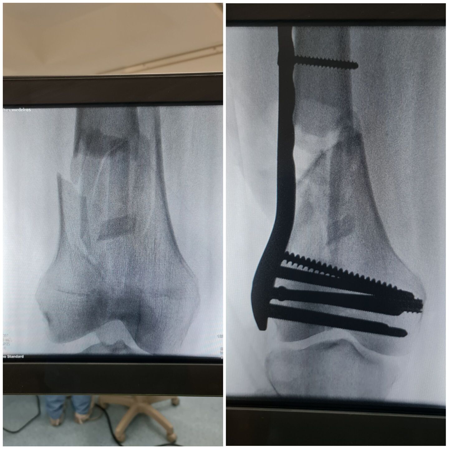 fratura-do-femur-distal-5
