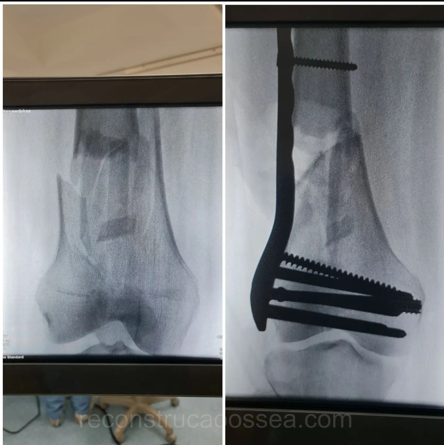 fratura-do-femur-distal-7