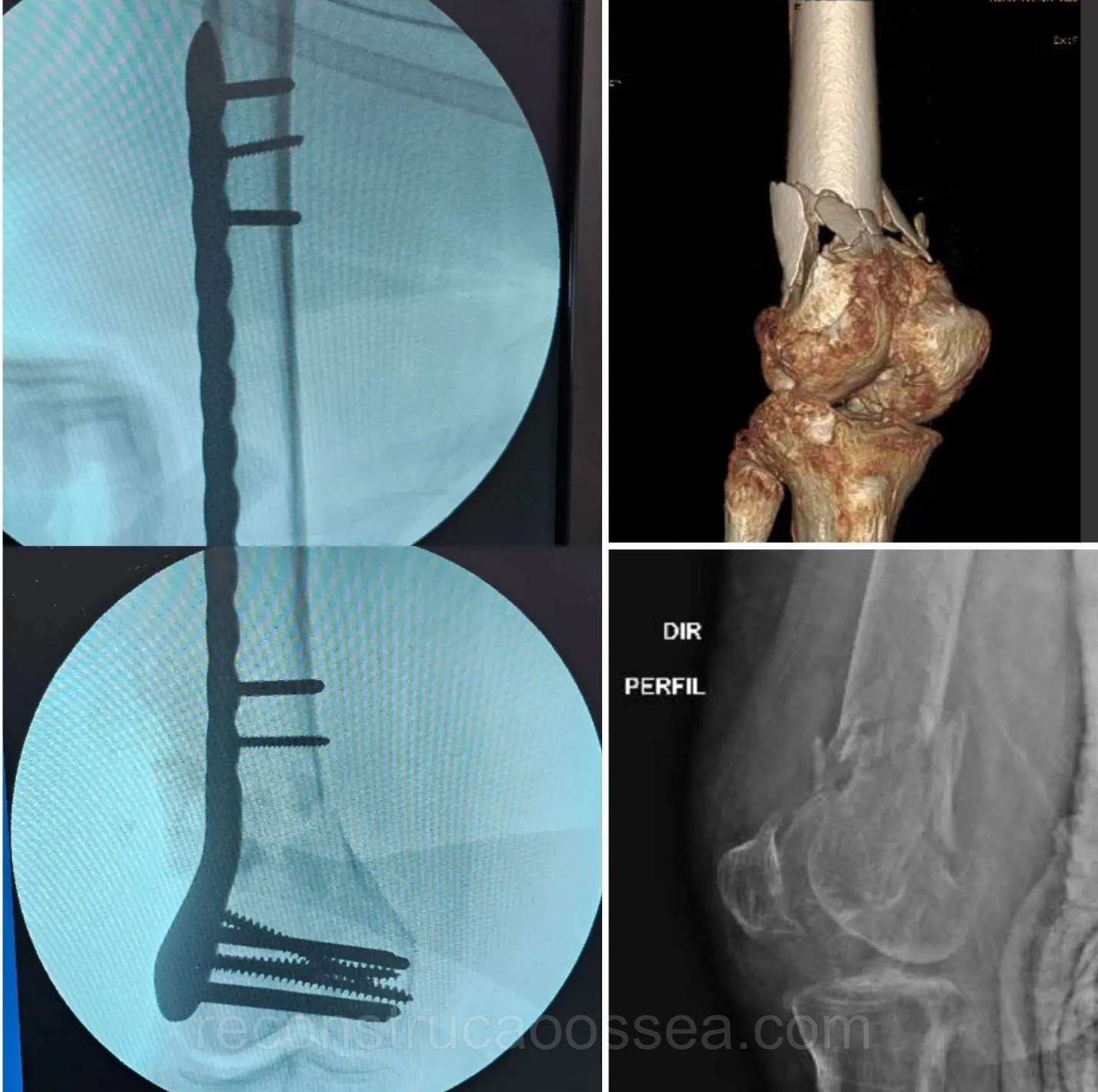 fratura-do-femur-distal-8