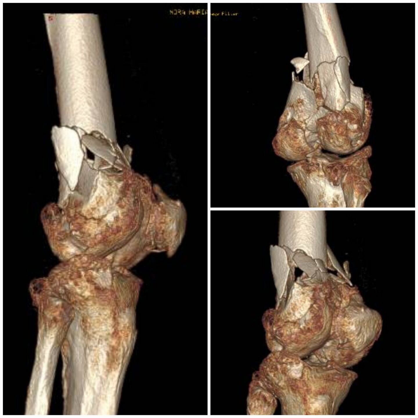 fratura-do-femur-distal3