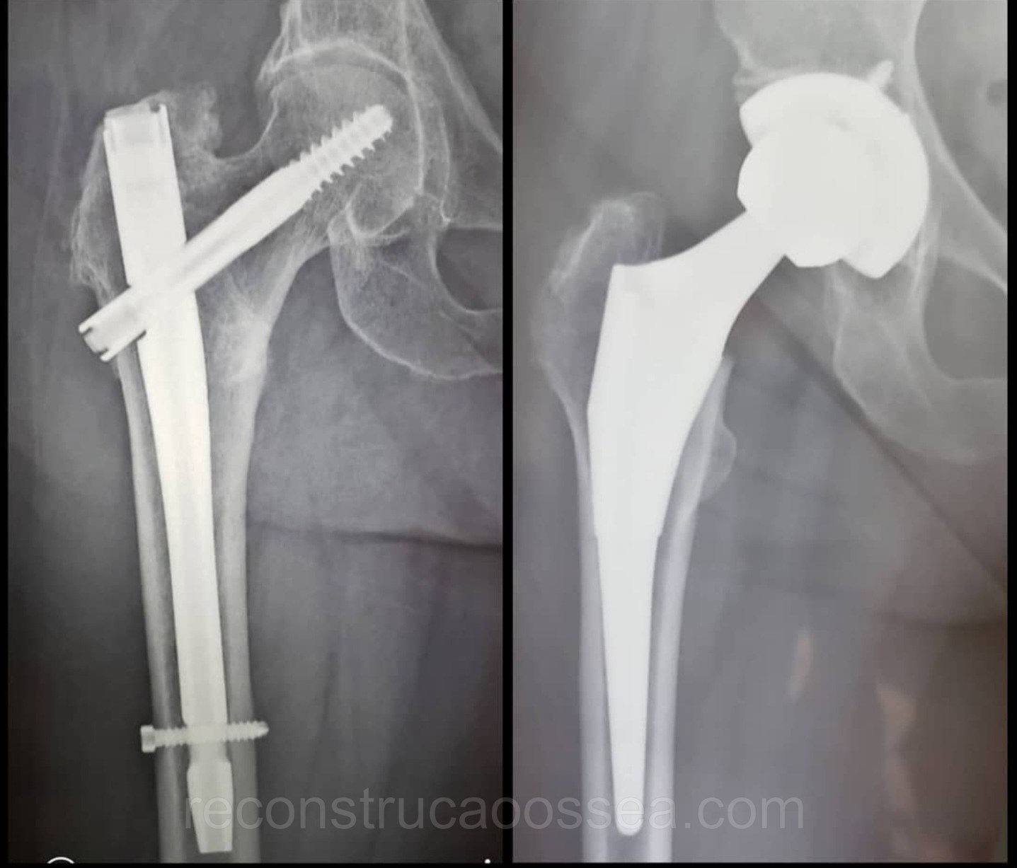 fratura-do-femur-proximal-tratamento-cirurgico-1