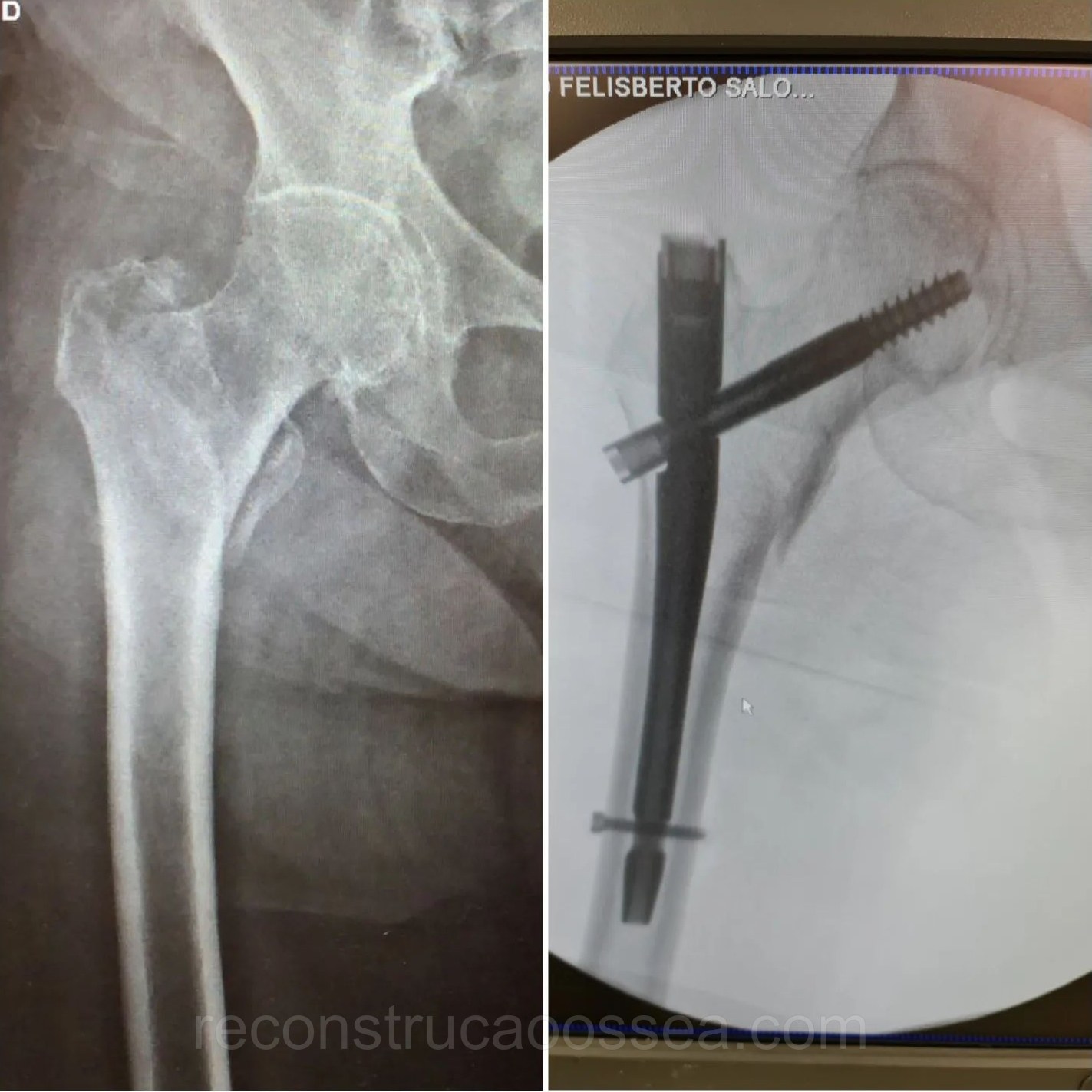 fratura-do-femur-proximal-tratamento-cirurgico-11