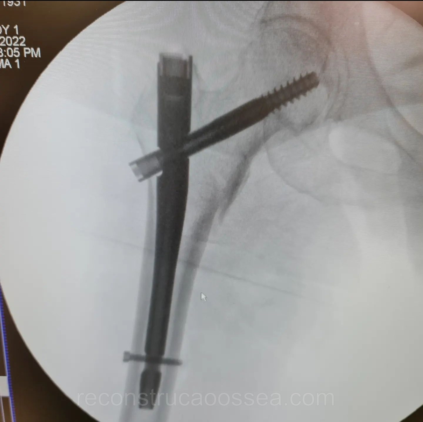 fratura-do-femur-proximal-tratamento-cirurgico-13