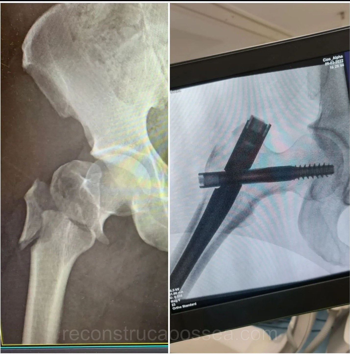 fratura-do-femur-proximal-tratamento-cirurgico-14