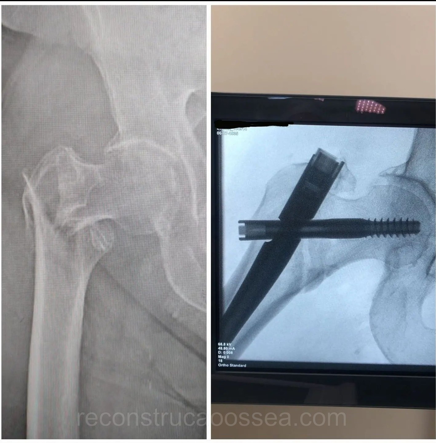 fratura-do-femur-proximal-tratamento-cirurgico-15