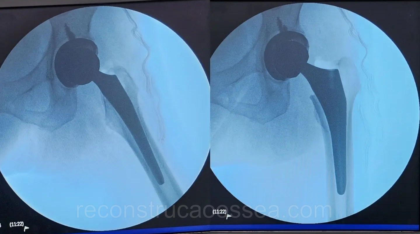 fratura-do-femur-proximal-tratamento-cirurgico-21