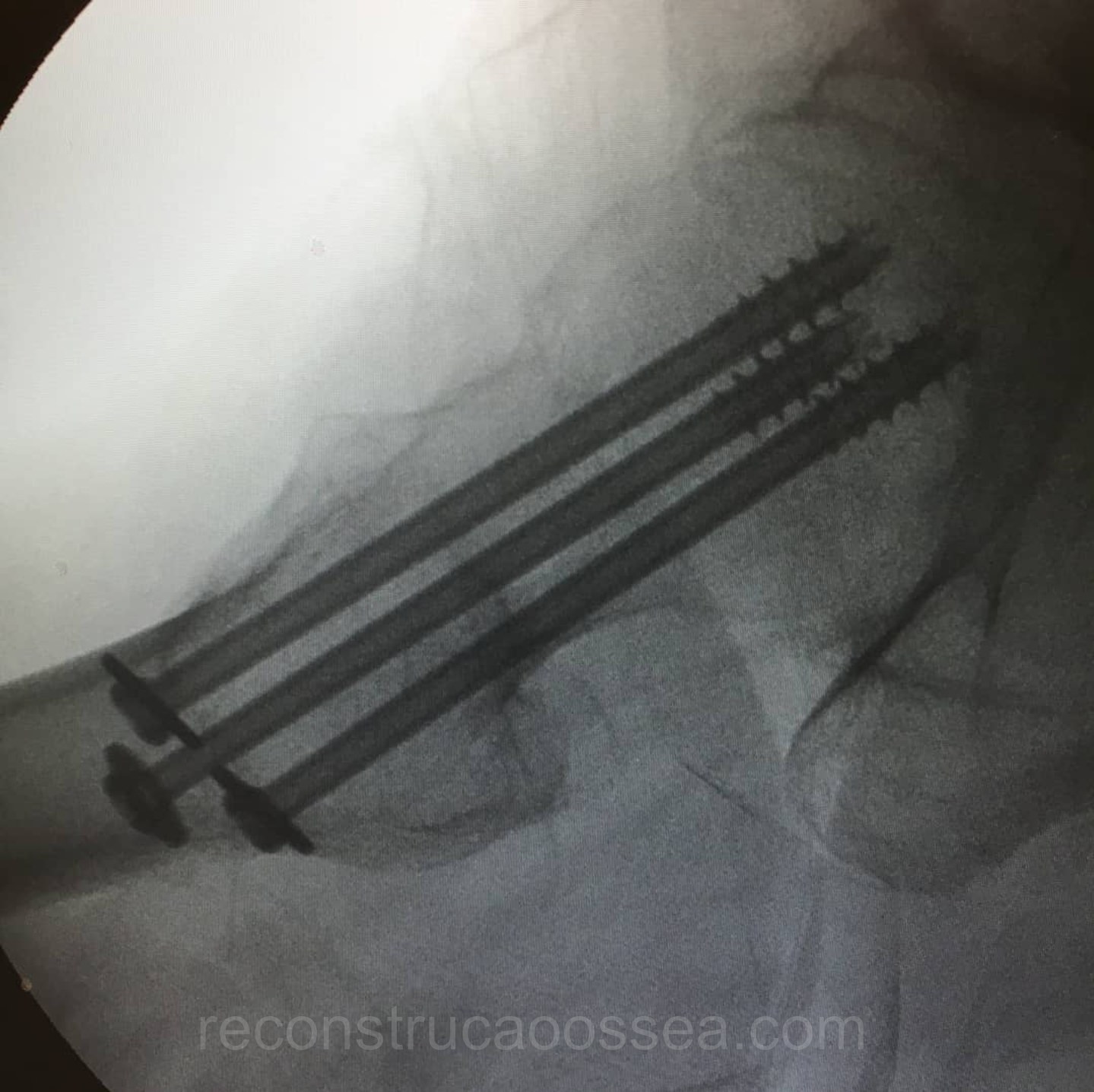 fratura-do-femur-proximal-tratamento-cirurgico-4
