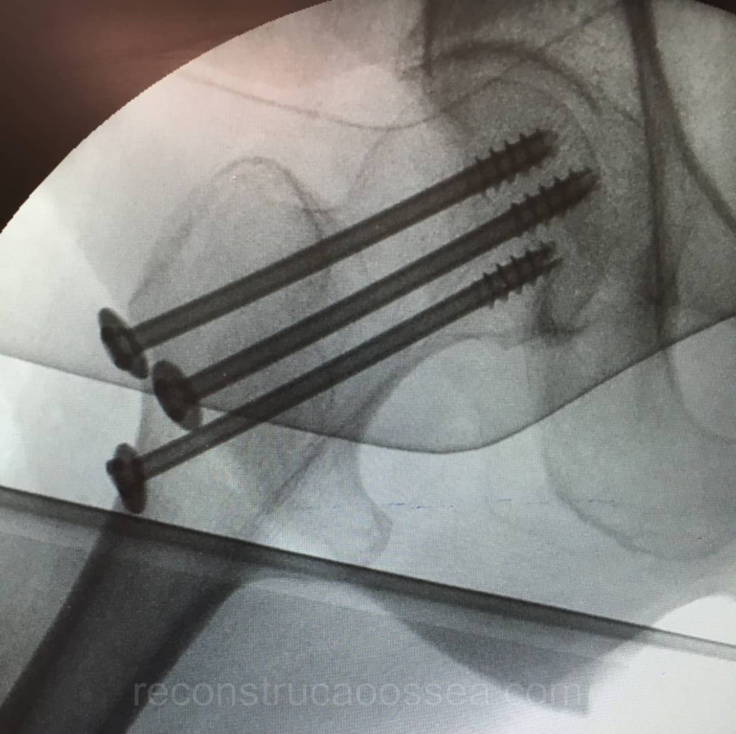 fratura-do-femur-proximal-tratamento-cirurgico-5