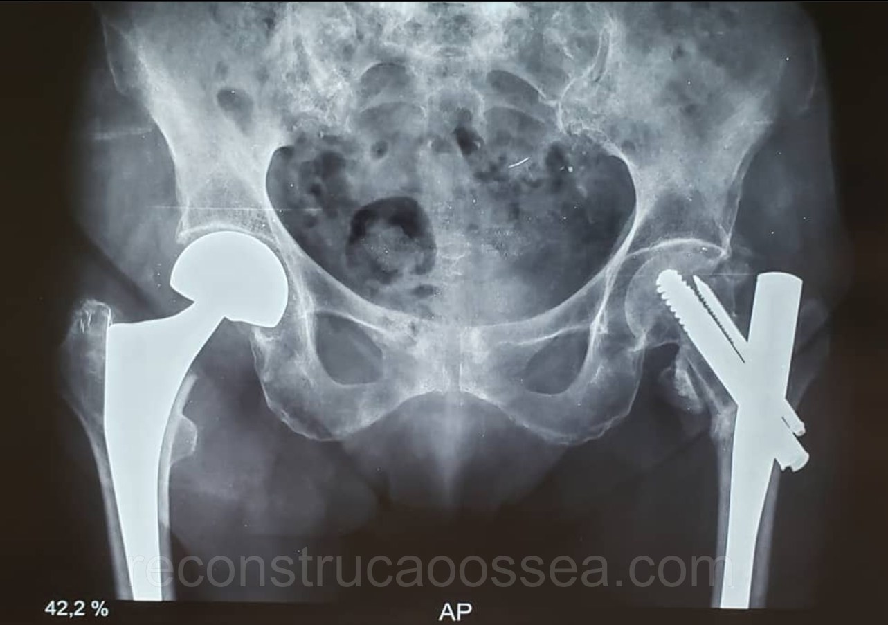 fratura-do-femur-proximal-tratamento-cirurgico-6
