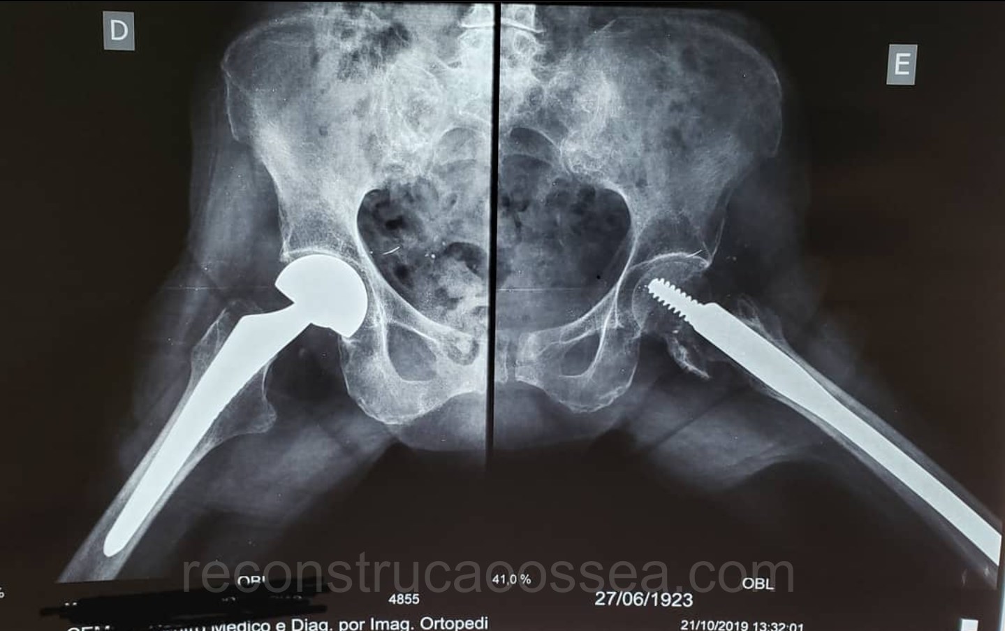 fratura-do-femur-proximal-tratamento-cirurgico-7